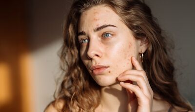 Akné u teenagerů nejsou jen pupínky