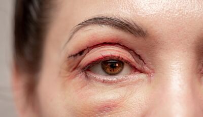 Kosmetické zákroky: Kde končí estetika a začíná zdraví